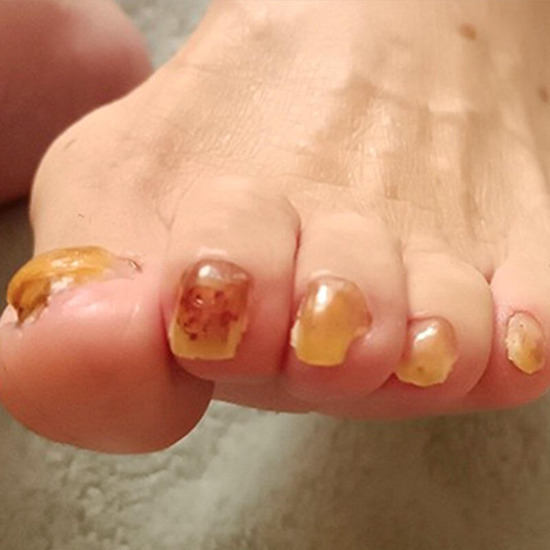 厚い爪・変形爪ケア