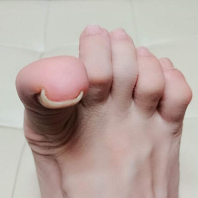 巻き爪ケア